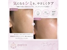 パピコアイラッシュ(papico_eyelash)の雰囲気（低周波のやさしいシミケアでお肌への負担を抑えながらアプローチ）
