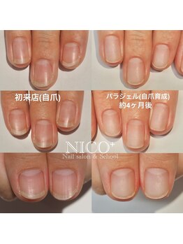 ニコプラス(NICO+)/自爪育成中