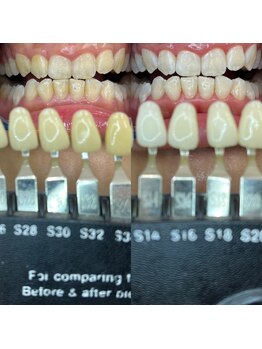 トウキョースワーズ 渋谷店(TOKYO SWRS)/#ホワイトニング #渋谷 #池袋