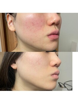 ミーツ(MEETS)/肌荒れ徹底改善 左