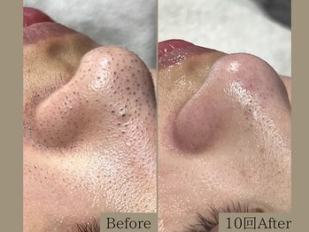 ティーツリー 名古屋 桜山(Tea Tree)/【毛穴ケア・毛穴洗浄】