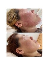 ニキビケア研究所 吉祥寺店/赤みの強いニキビにも◎