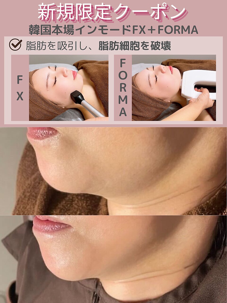【小顔・切らないリフト】小顔インモード(FX+FORMA)\13000