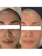 アーネスト 大阪心斎橋店(EARNEST)/肌質改善【 水光ピーリング 】