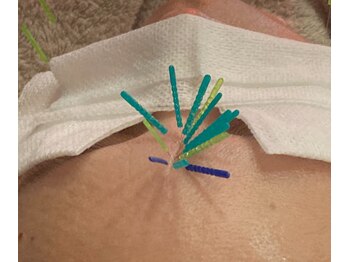 ミエリア美容鍼灸院(mielia美容鍼灸院)の写真/他では続かなかった、満足できなかった方や美容鍼灸は気になるけど初めてで不安な方にも◎