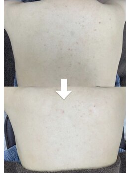 カルディエ(Cardie)/BODYハーブピーリング