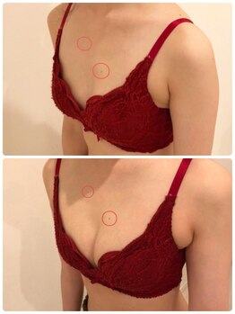 リール 新宿店(RIRE)/30代前半 バストアップ症例