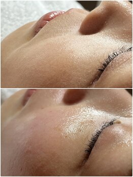 スパークル/ニキビ予防/毛穴/フェイシャル