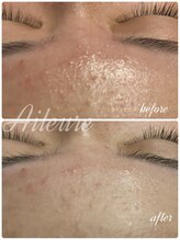 エルール トータルビューティ(Aileure total beauty)/最新ピーリング　ララピール