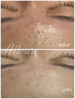 エルール トータルビューティ(Aileure total beauty)/最新ピーリング　ララピール