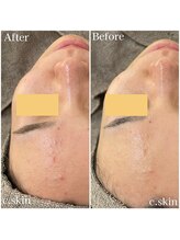 シースキン 盛岡駅前店(c.skin)/お客様ビフォーアフター♪