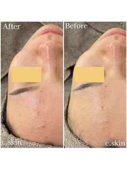シースキン 盛岡駅前店(c.skin)/お客様ビフォーアフター♪