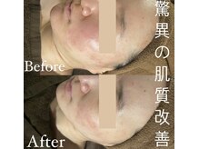 カヨン 新所沢店(KAYON)/ハーブピーリング Before→After