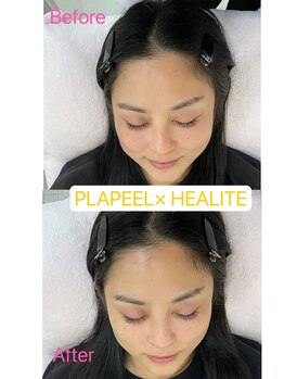 ドルチェナッツ ネオ 府内店(dolce nuts NEO)/第5世代プラピール＋ヒーライト