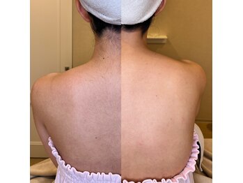 リンド エステ まつげ 京成大久保(Lind)/ブライダルシェービング