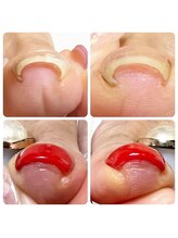 ハウオリ ネイル(Hauoli nail)/巻き爪補正(ジェル)