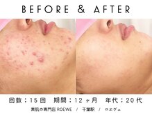 ロエヴェ(ROEWE)/ニキビ改善・毛穴ケア・肌質改善