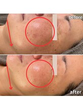 モーイエンチャーム(mooi en charme)/生ヒト幹細胞高濃度導入エステ★