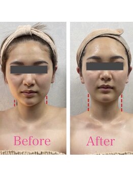 TKC 東京小顔センター五反田店/ ビフォーアフター【対称/首長】