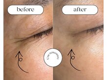 ユヌランコント 岐阜店(Une rencontre)/エンビロンビタミン導入ラジオ波