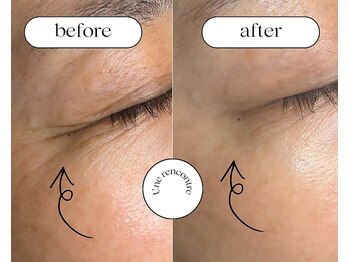 ユヌランコント 岐阜店(Une rencontre)/エンビロンビタミン導入ラジオ波