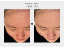 ベル 新橋(Belle)/ハーブピーリング×ニキビケア