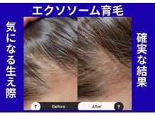 アン 銀座(ann)の雰囲気（毛が生える環境を再生する施術。頭皮にエクソソーム。リフトUP◎）