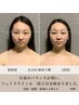 【エラ張り・お顔の左右差改善】徹底小顔特化◎本格小顔矯正+頭蓋骨コルギ