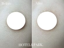 ホテルアンドパーク(HOTEL&PARK.)/バストワックス脱毛