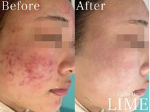 ライム 渋谷(LIME)の雰囲気（お客様のお肌悩みに合わせた、丁寧なカウンセリング♪）