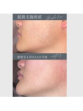 レオナルド(Leonardo)/ヒゲ脱毛で肌もキレイに！