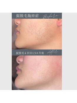 レオナルド(Leonardo)/ヒゲ脱毛で肌もキレイに!