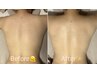 【夏限定/毛穴レス美白】背中毛穴洗浄×美白パック付き☆ニキビケア◎7700円
