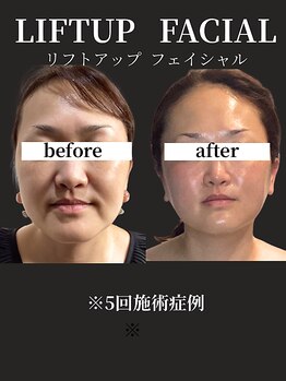 ノーブルノアール(Noble noir)/二重あご/たるみケア