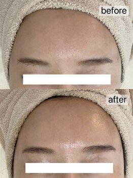 フェリノ(FERINO)/エクソソームハーブピーリング