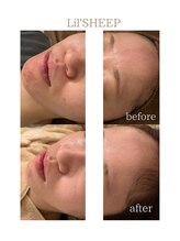 リルシープ(LIL'SHEEP)/エクソソームハーブピーリング