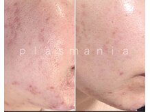 グラースア(grace a)/プラズマニア