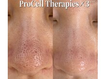 レイ(Rey)の雰囲気（プロセルセラピーズで陥没毛穴のケア。頬の開き毛穴も修正します）