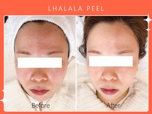 シロカネ イオンタウン西熊本店(SHIROKANE)/韓国肌管理ララピール☆