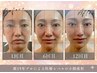 【新規様/3名限定】毛穴専門店のエクストラクション＋ビタC生パック¥10900→