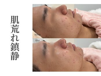 エトレ(etre)/毛穴/ニキビケア/フェイシャル