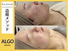 アルゴ 小倉守恒店(ALGO)/造顔メソッド