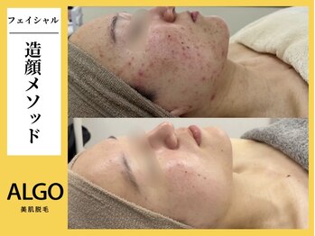 アルゴ 小倉守恒店(ALGO)/造顔メソッド