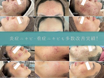 ニキビケア研究所 本厚木店の写真