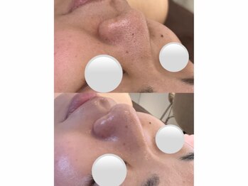 サロン ド チョコ(SALON DU CHOCO)/毛穴洗浄でイチゴ鼻改善