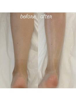 グレアージュ(GLEAGE)/全身痩身凹凸脂肪コース!