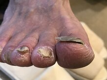 アトリエ整骨院/変形爪