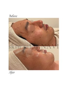 ナビ(NAVI)/ニキビケア赤み鎮静／SOS肌管理