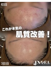 ジェノール 飾磨本店(JNOEL)/結果重視の肌質改善