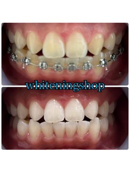 ホワイトニングショップ 豊川店/Before After豊川ホワイトニング